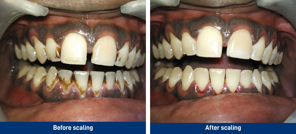Ultrasonic Scaling