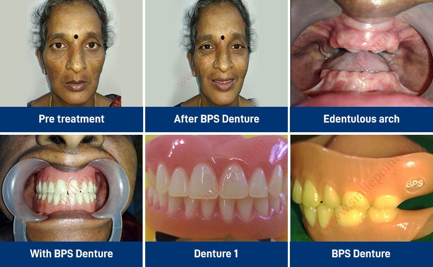 Dentures