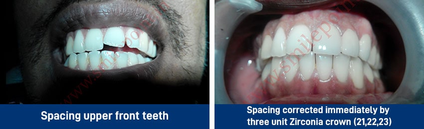 Ceramic & Zirconia
