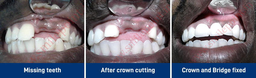 Ceramic & Zirconia