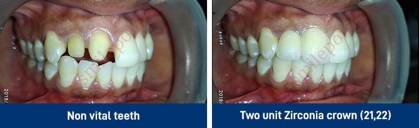 Ceramic & Zirconia