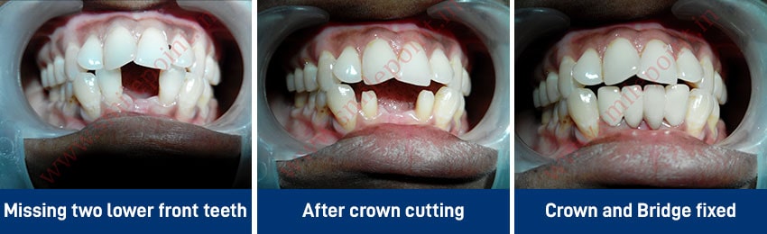 Ceramic & Zirconia