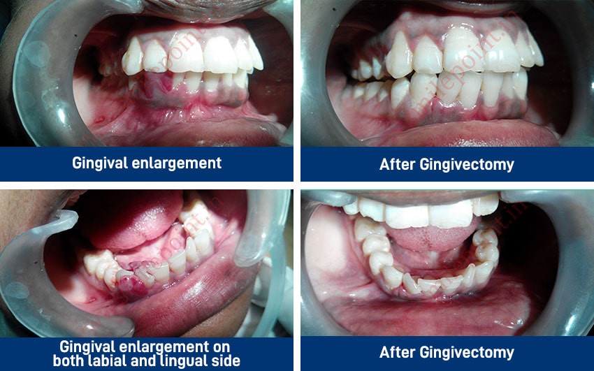 Gum Care Surgery