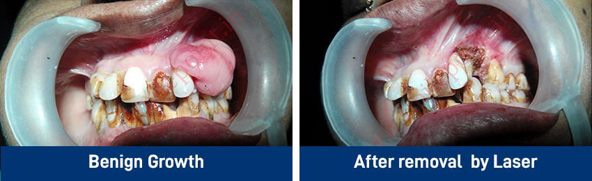 Laser Dentistry