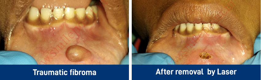 Laser Dentistry