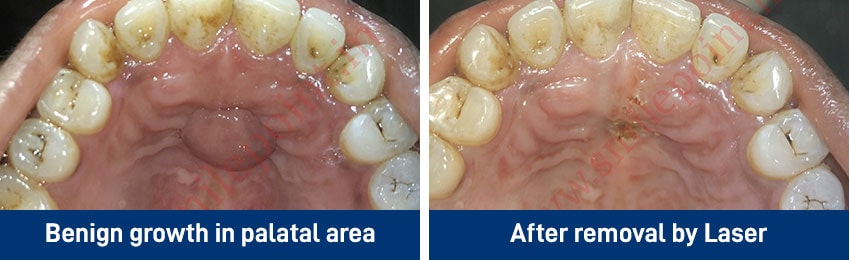 Laser Dentistry