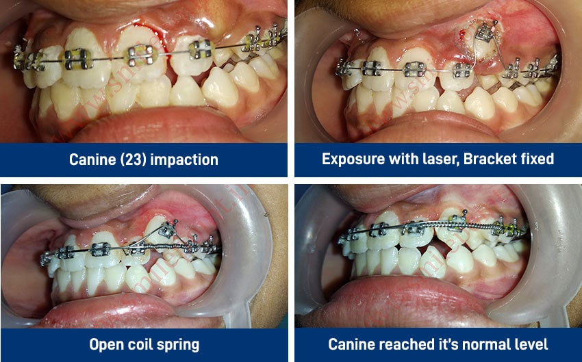 Teeth Alignment